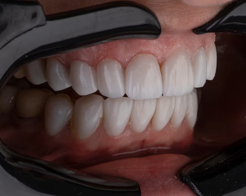 Sonrisa luminosa tras un blanqueamiento dental profesional en la Clínica Dr. Baos de Argés, Toledo