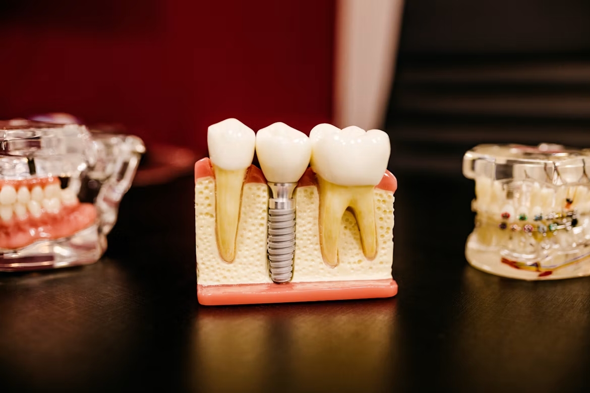 Implante dental de titanio con corona, tratamiento de implantología en la Clínica Dr. Baos de Argés, Toledo