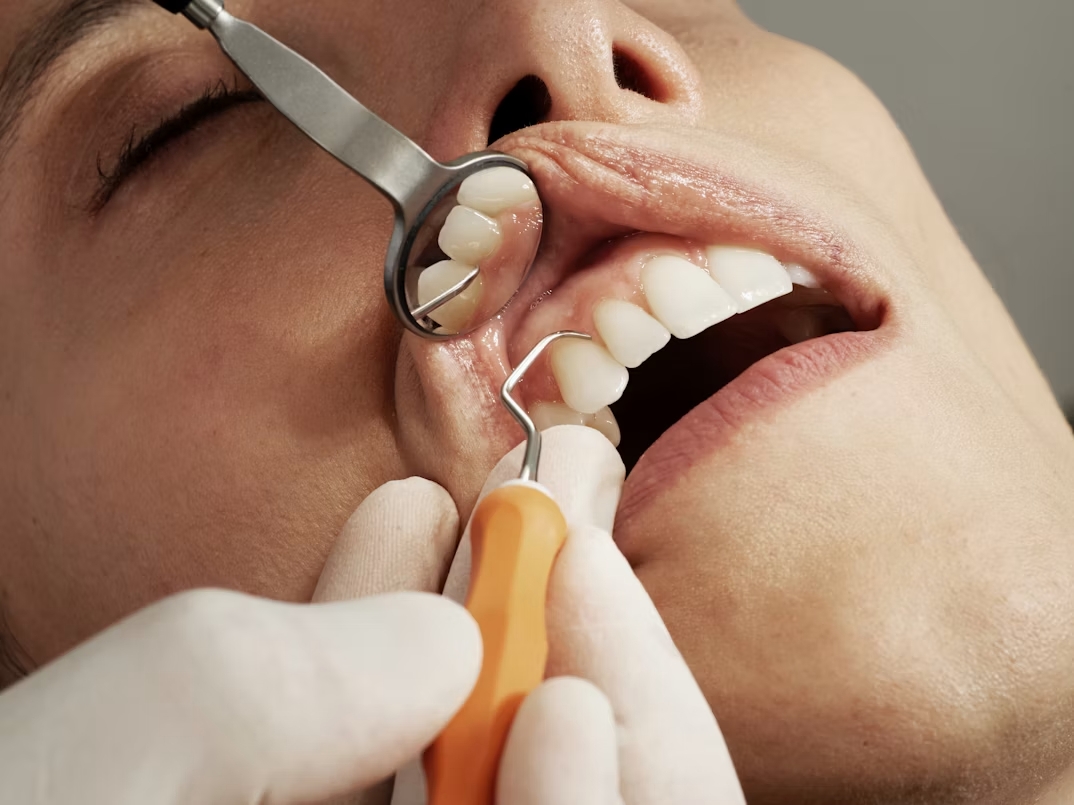 Implante dental de titanio con su corona, tratamiento de implantología en la Clínica Dr. Baos de Argés, Toledo