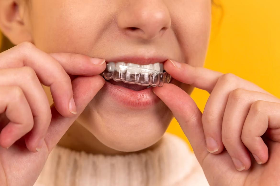 Alineador transparente de ortodoncia invisible Invisalign en la Clínica Dr. Baos de Argés, Toledo